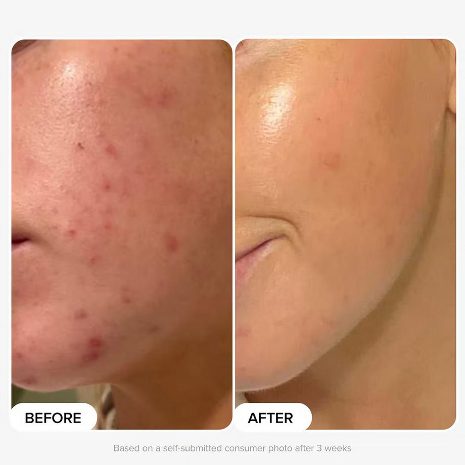 Paula's Choice  Multi-Level Exfoliation Trial Kit - Duo Découverte Exfoliants AHA + BHA 