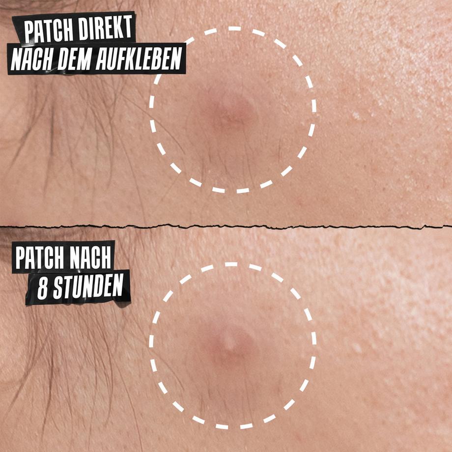 Kiehl's  Truly Targeted Overnight Blemish Patches 