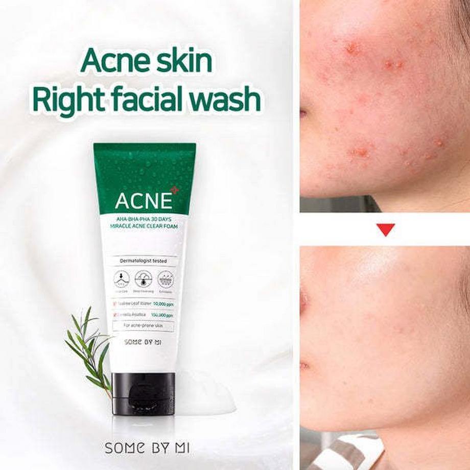 Some By Mi  30 Days Miracle Acne Clear Foam 