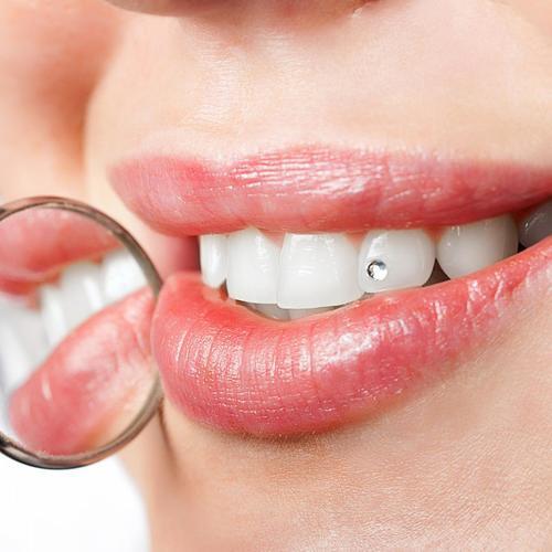 Image of Zahnschmuck & Kontrolle In Zürich (für 1 Person) Unisex