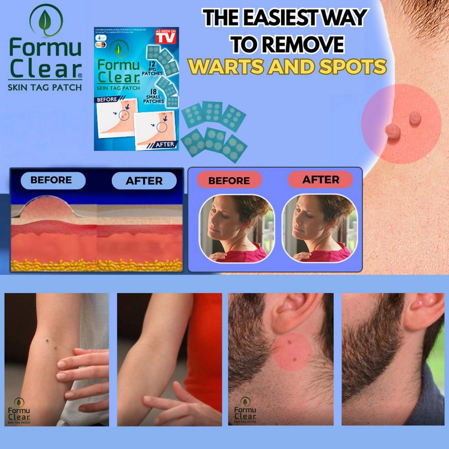 BEST DIRECT  FORMUCLEAR Skin Tag Patch - Cerotti per verruche 