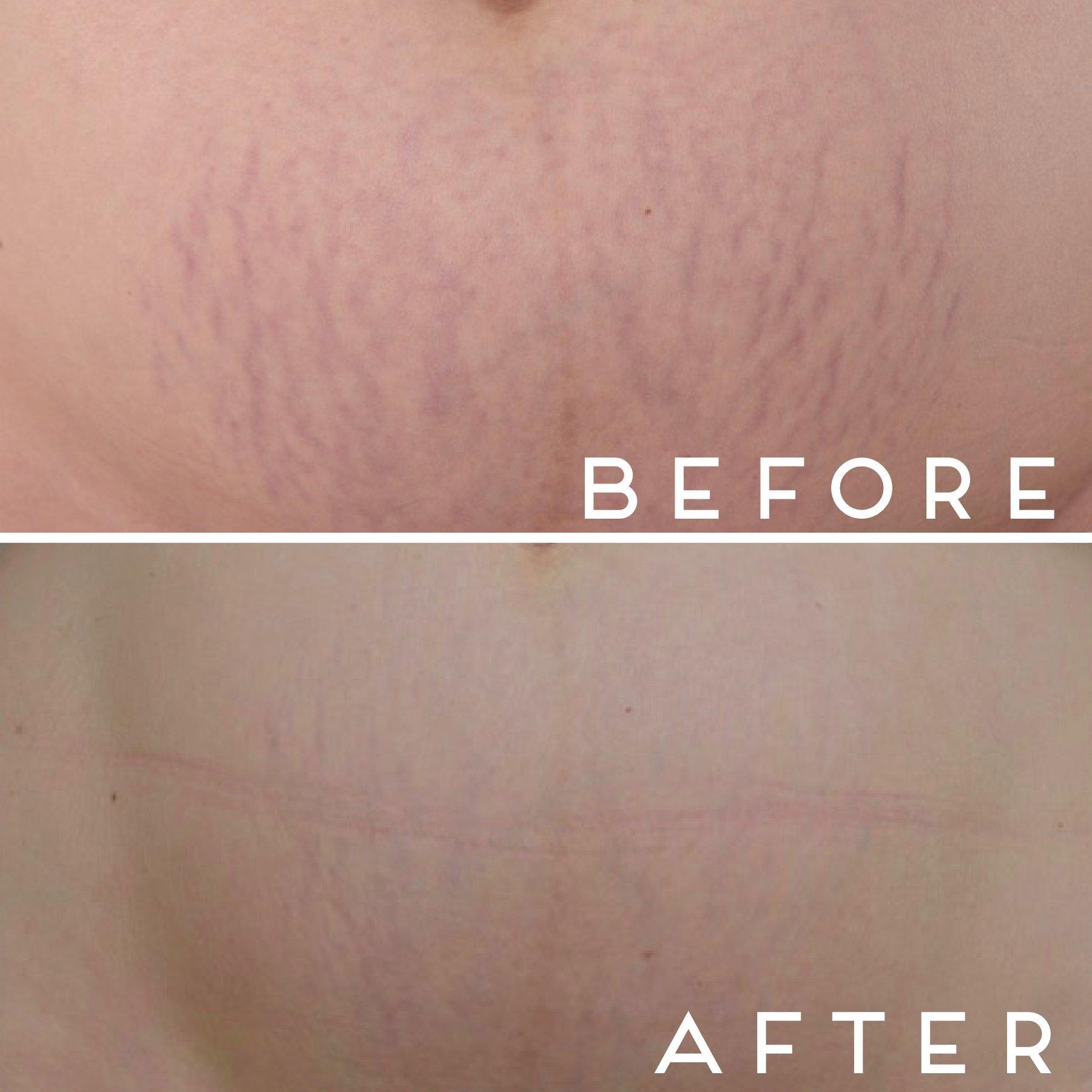 Decalys Switzerland  DECALYS Medical La  pommade - soin remodelant &amp; prévention cicatrice et vergetures 