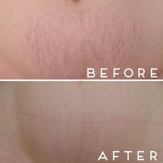 Decalys Switzerland  DECALYS Medical La  pommade - soin remodelant &amp; prévention cicatrice et vergetures 