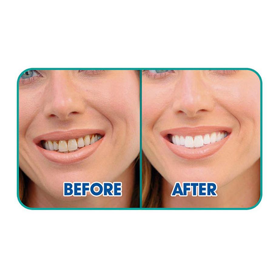 STARLYF ULTRASONIC - Vibrationszahnreiniger  