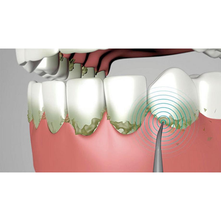 STARLYF ULTRASONIC - Vibrationszahnreiniger  